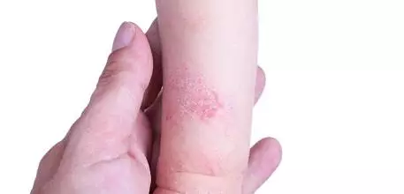 Patient with eczema